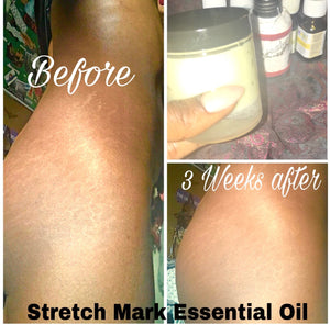 Stretch Mark Solution